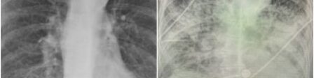 oscabecasdanoticia-pulmo.jpg