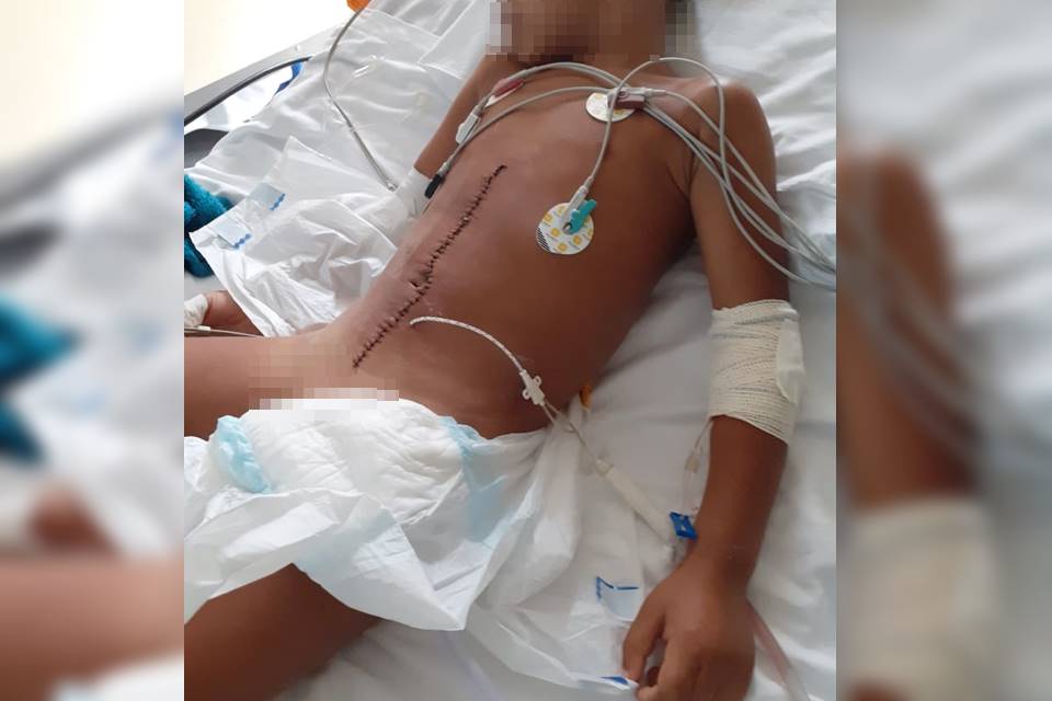 Menino cicatriz na barriga