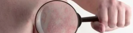 oscabecasdanoticia-herpe.webp