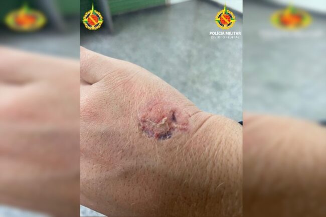 oscabecasdanoticia-mulhe mão mordida de PM - Metrópoles