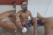 Homem teve rosto e parte do corpo queimado