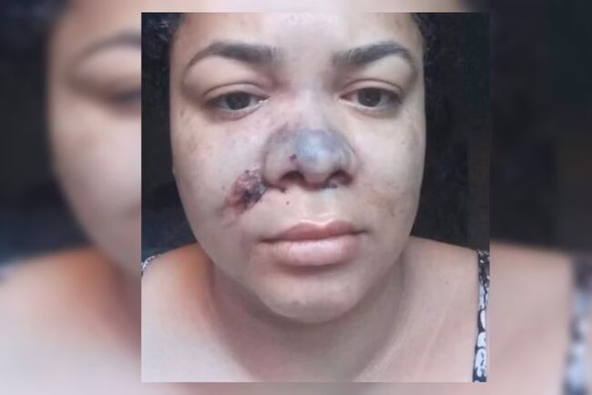Mulher perde nariz em procedimento estético no DF