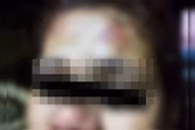 Foto de uma lesão na testa da mulher agredida pelo companheiro