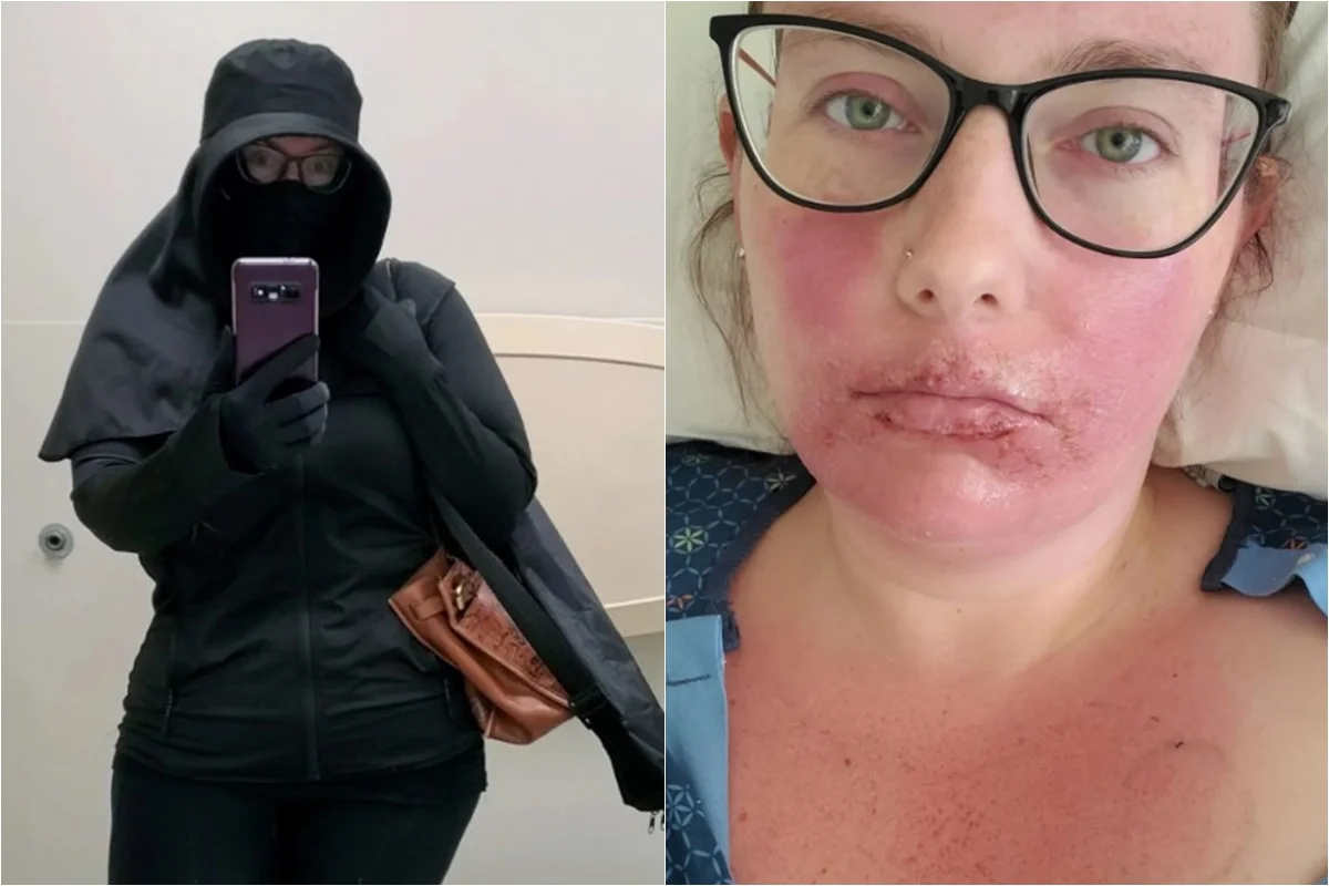 Duas fotos de mulher, uma com roupa preta e a outra com alergia na boca - Metrópoles