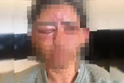 Hematoma no olho